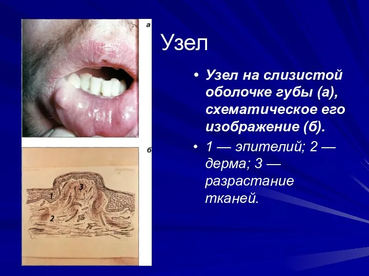 Узел Узел на слизистой оболочке губы (а), схематическое его изображение