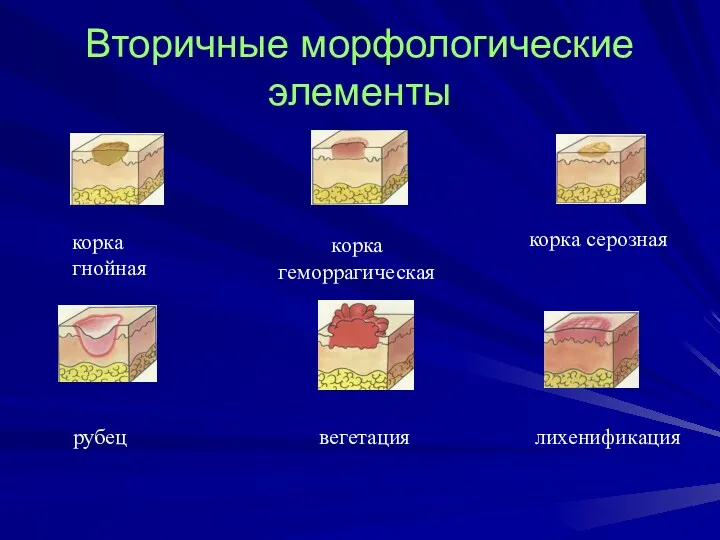 Вторичные морфологические элементы корка гнойная корка геморрагическая корка серозная рубец вегетация лихенификация