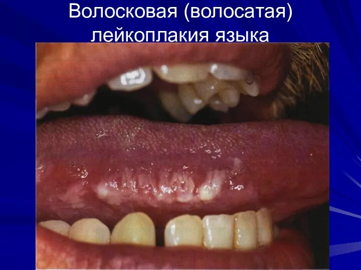 Волосковая (волосатая) лейкоплакия языка
