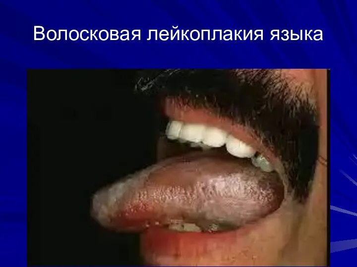 Волосковая лейкоплакия языка