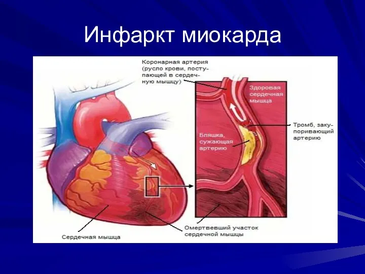 Инфаркт миокарда