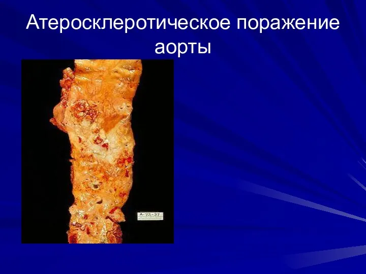 Атеросклеротическое поражение аорты