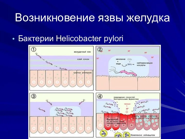 Возникновение язвы желудка Бактерии Helicobacter pylori