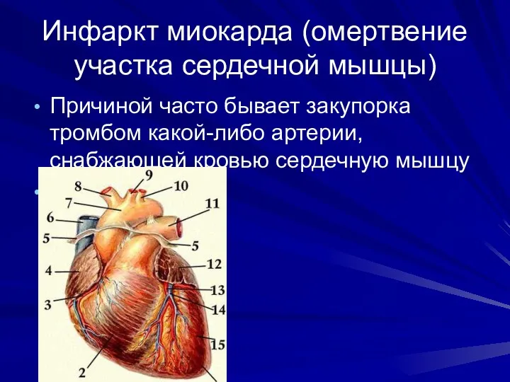 Инфаркт миокарда (омертвение участка сердечной мышцы) Причиной часто бывает закупорка тромбом какой-либо артерии,