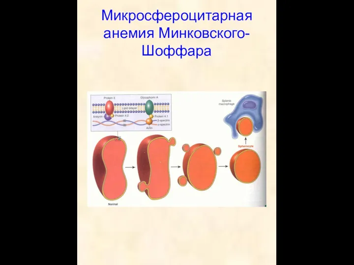 Микросфероцитарная анемия Минковского-Шоффара