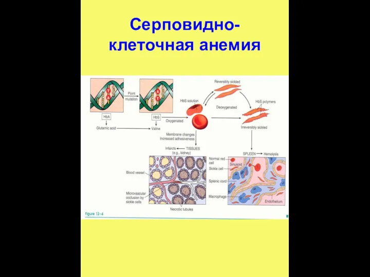 Серповидно-клеточная анемия