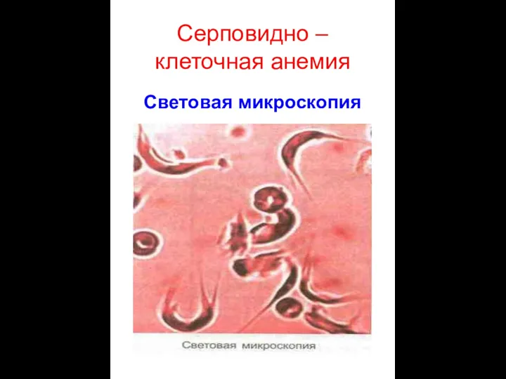 Серповидно – клеточная анемия Световая микроскопия