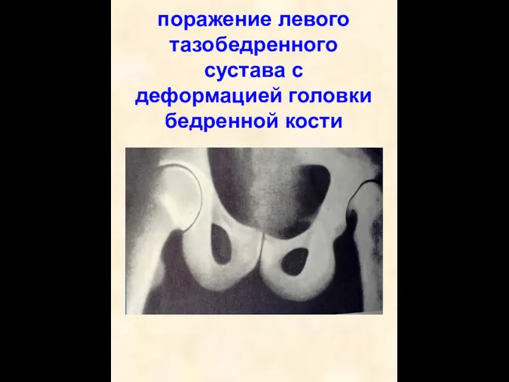 поражение левого тазобедренного сустава с деформацией головки бедренной кости