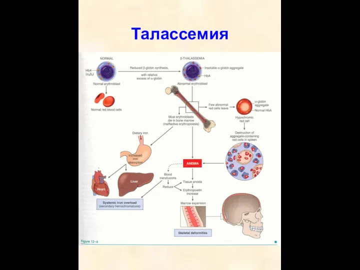 Талассемия