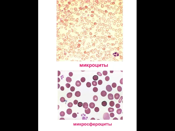 микросфероциты микроциты