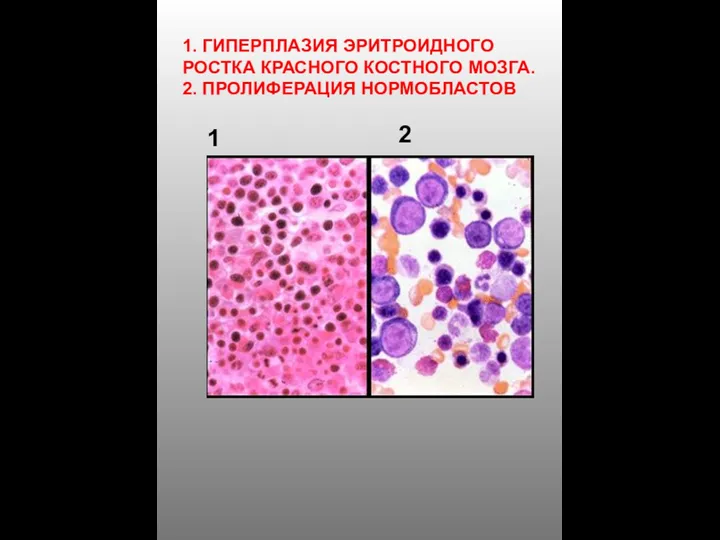 1. ГИПЕРПЛАЗИЯ ЭРИТРОИДНОГО РОСТКА КРАСНОГО КОСТНОГО МОЗГА. 2. ПРОЛИФЕРАЦИЯ НОРМОБЛАСТОВ 1 2