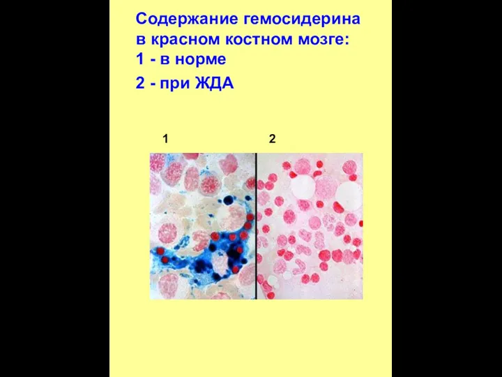 Содержание гемосидерина в красном костном мозге: 1 - в норме 2 - при ЖДА 1 2