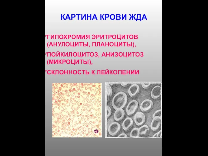 КАРТИНА КРОВИ ЖДА ГИПОХРОМИЯ ЭРИТРОЦИТОВ (АНУЛОЦИТЫ, ПЛАНОЦИТЫ), ПОЙКИЛОЦИТОЗ, АНИЗОЦИТОЗ (МИКРОЦИТЫ), СКЛОННОСТЬ К ЛЕЙКОПЕНИИ