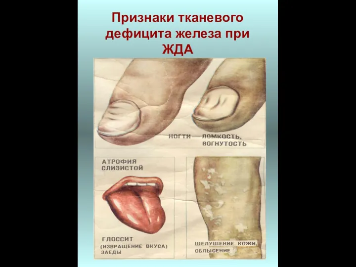 Признаки тканевого дефицита железа при ЖДА