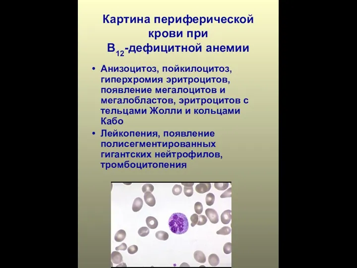Картина периферической крови при В12-дефицитной анемии Анизоцитоз, пойкилоцитоз, гиперхромия эритроцитов,