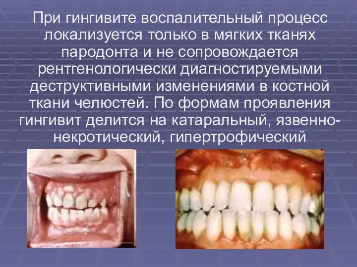 При гингивите воспалительный процесс локализуется только в мягких тканях пародонта