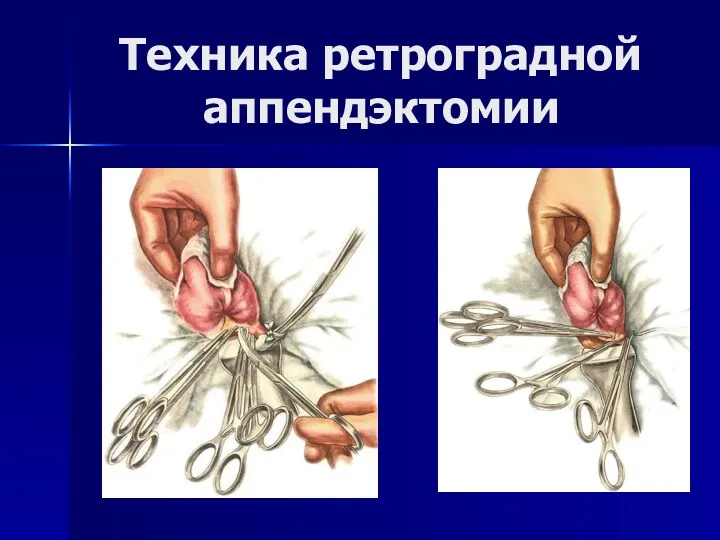 Техника ретроградной аппендэктомии