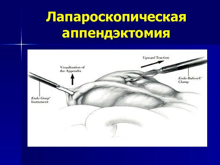 Лапароскопическая аппендэктомия