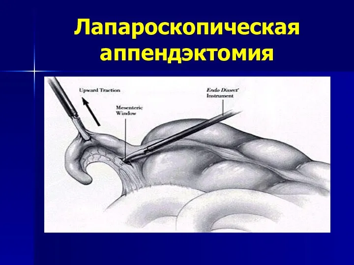 Лапароскопическая аппендэктомия