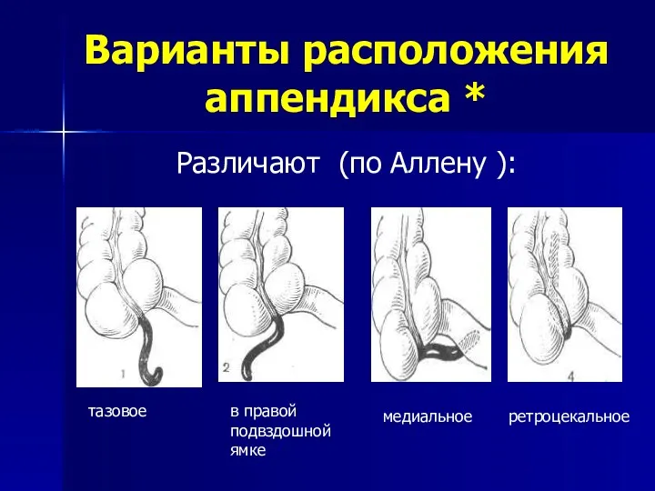 Варианты расположения аппендикса * Различают (по Аллену ): тазовое в правой подвздошной ямке медиальное ретроцекальное