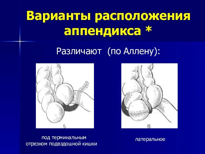 Варианты расположения аппендикса * Различают (по Аллену): под терминальным отрезком подвздошной кишки латеральное