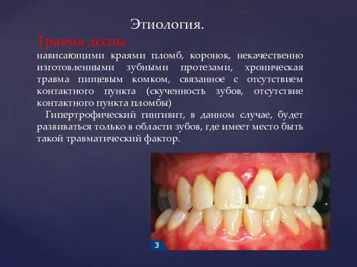 Этиология. Травма десны нависающими краями пломб, коронок, некачественно изготовленными зубными