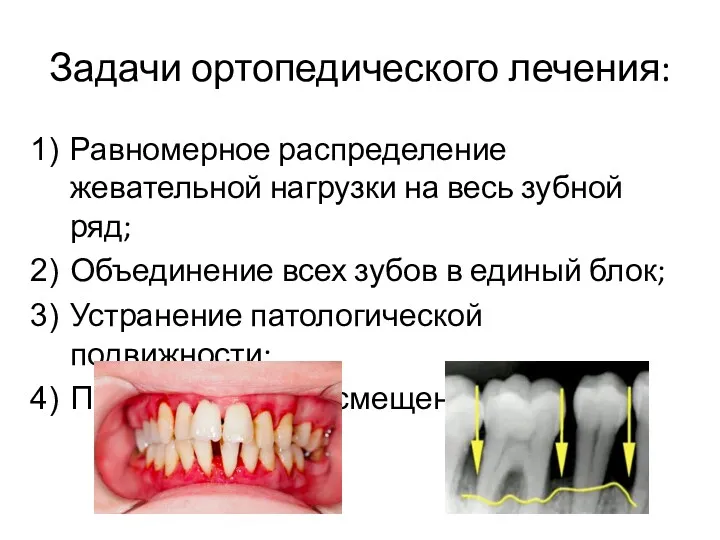 Задачи ортопедического лечения: Равномерное распределение жевательной нагрузки на весь зубной
