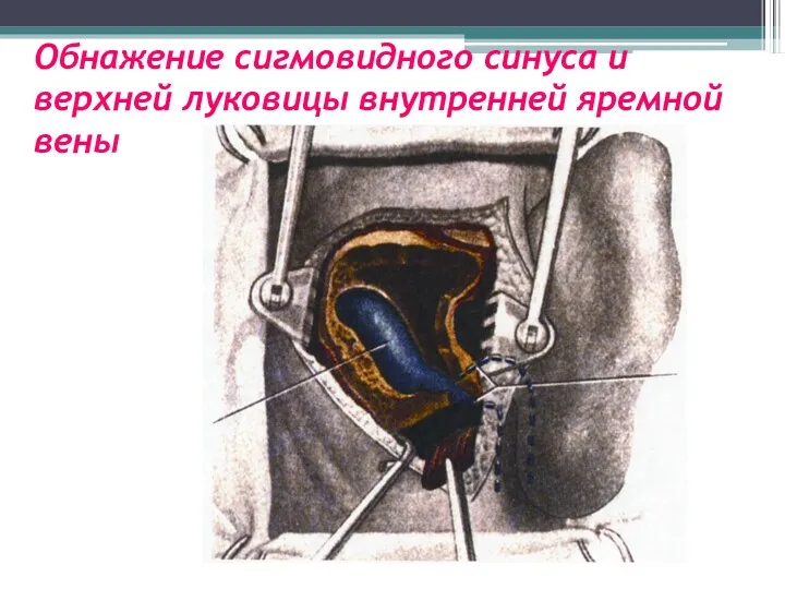 Обнажение сигмовидного синуса и верхней луковицы внутренней яремной вены