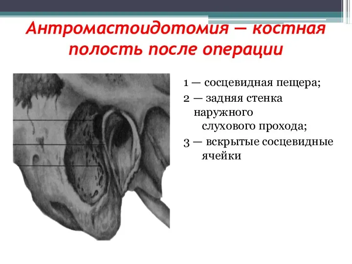 Антромастоидотомия — костная полость после операции 1 — сосцевидная пещера;
