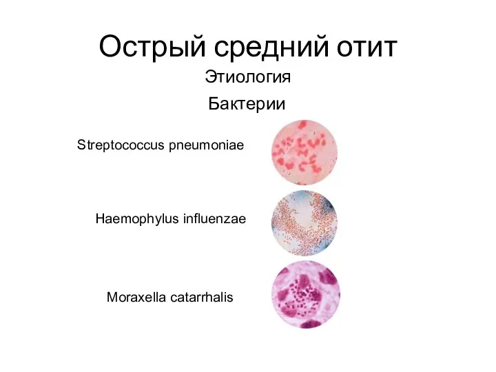Острый средний отит Этиология Бактерии Streptococcus pneumoniae Haemophylus influenzae Moraxella catarrhalis