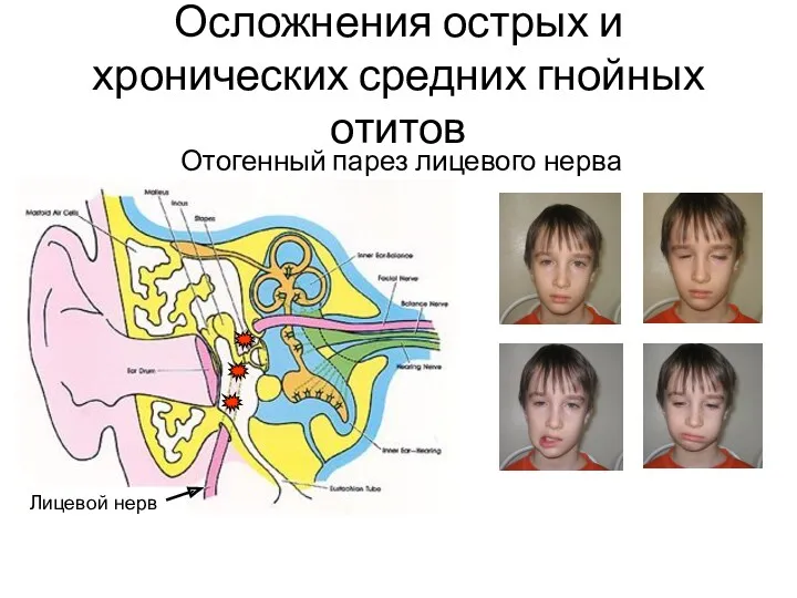 Осложнения острых и хронических средних гнойных отитов Отогенный парез лицевого нерва Лицевой нерв