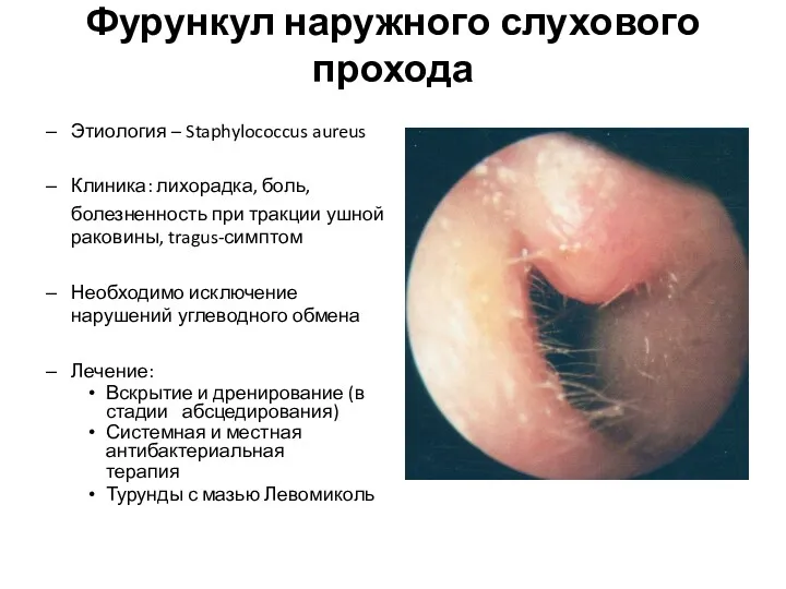 Фурункул наружного слухового прохода Этиология – Staphylococcus aureus Клиника: лихорадка,