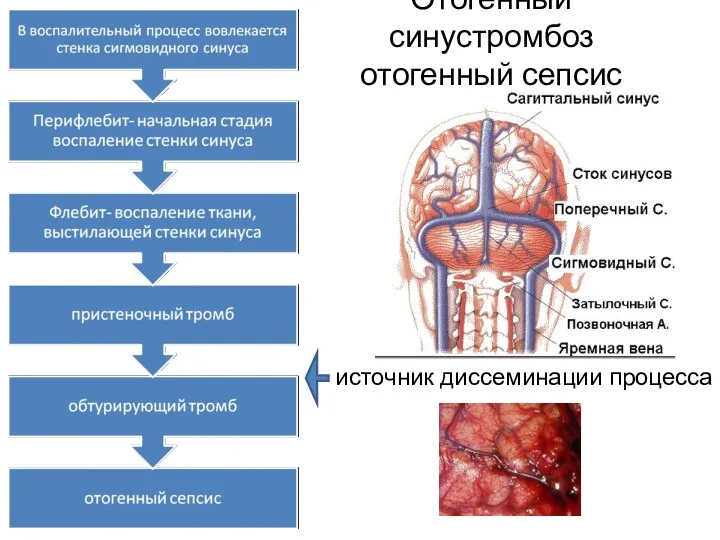 Отогенный синустромбоз отогенный сепсис источник диссеминации процесса