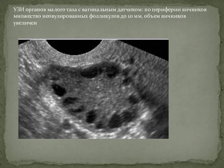 УЗИ органов малого таза с вагинальным датчиком: по периферии яичников множество неовулированных фолликулов