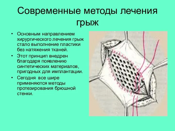 Современные методы лечения грыж Основным направлением хирургического лечения грыж стало