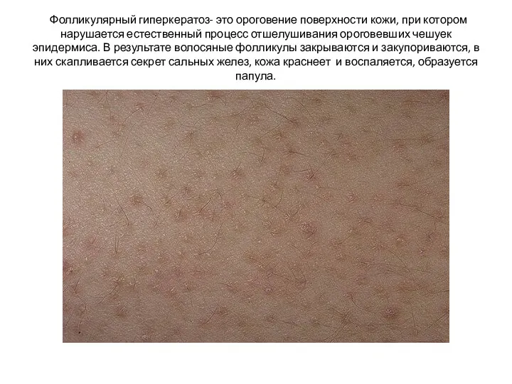Фолликулярный гиперкератоз- это ороговение поверхности кожи, при котором нарушается естественный процесс отшелушивания ороговевших