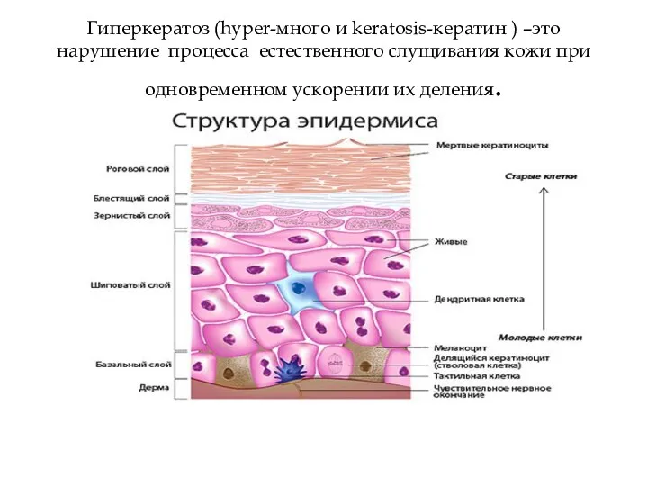 Гиперкератоз (hyper-много и keratosis-кератин ) –это нарушение процесса естественного слущивания кожи при одновременном ускорении их деления.