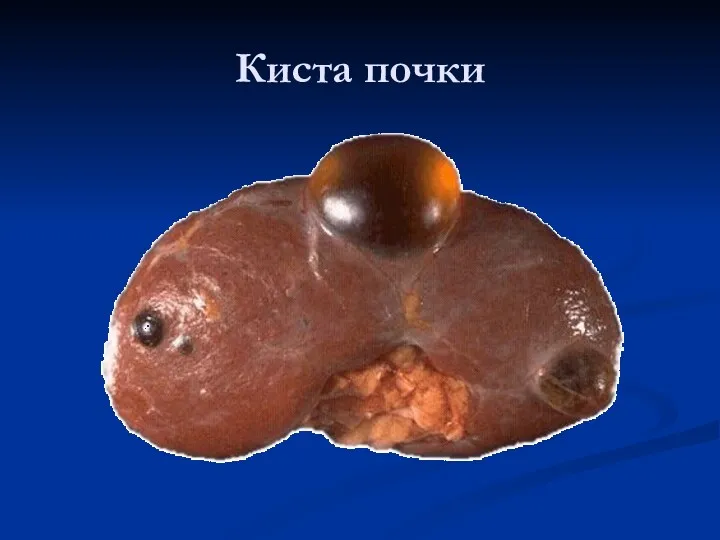 Киста почки