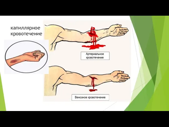 капиллярное кровотечение