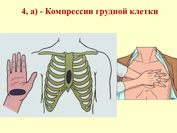 4, а) - Компрессии грудной клетки