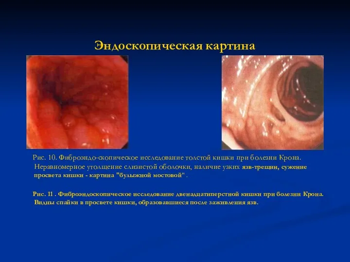 Эндоскопическая картина Рис. 10. Фиброэндо-скопическое исследование толстой кишки при болезни