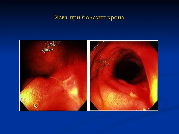 Язва при болезни крона