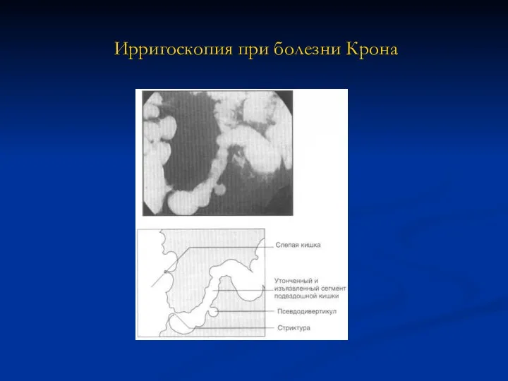 Ирригоскопия при болезни Крона