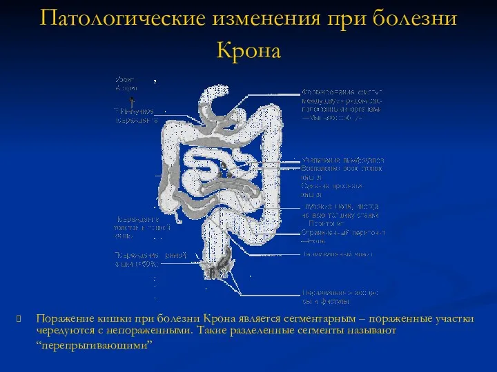 Патологические изменения при болезни Крона Поражение кишки при болезни Крона