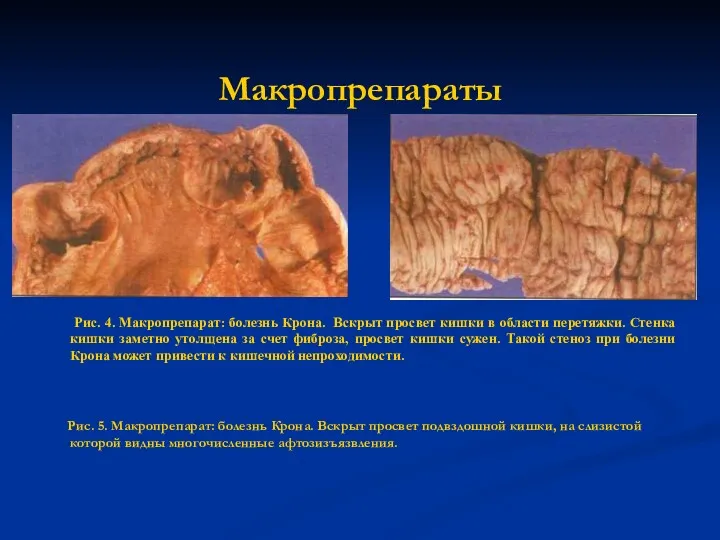 Макропрепараты Рис. 4. Макропрепарат: болезнь Крона. Вскрыт просвет кишки в