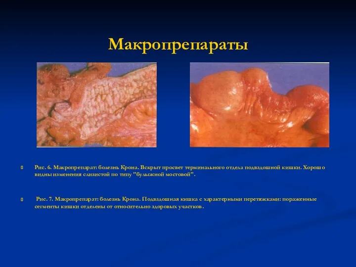 Макропрепараты Рис. 6. Макропрепарат: болезнь Крона. Вскрыт просвет терминального отдела