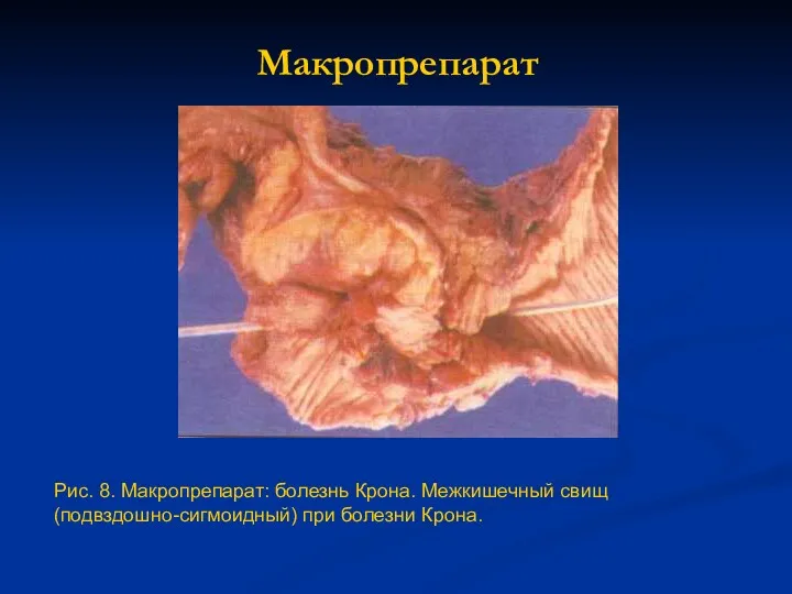 Макропрепарат Рис. 8. Макропрепарат: болезнь Крона. Межкишечный свищ (подвздошно-сигмоидный) при болезни Крона.