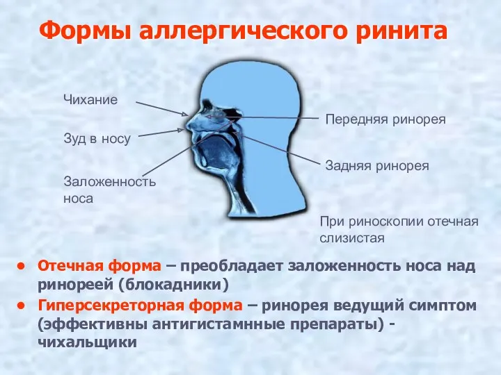 Формы аллергического ринита Отечная форма – преобладает заложенность носа над