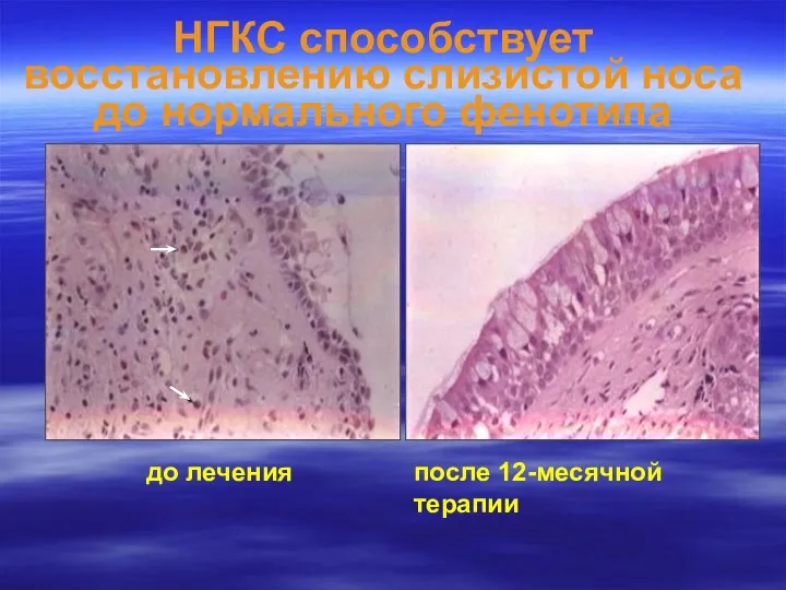 до лечения после 12-месячной терапии НГКС способствует восстановлению слизистой носа до нормального фенотипа