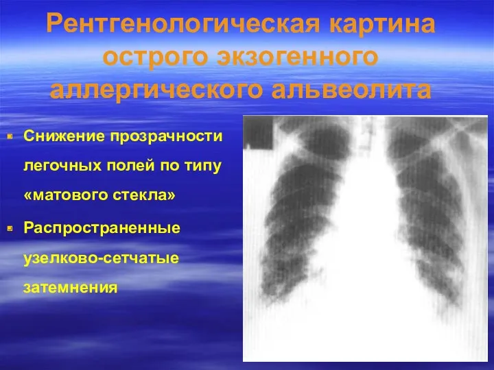 Рентгенологическая картина острого экзогенного аллергического альвеолита Снижение прозрачности легочных полей
